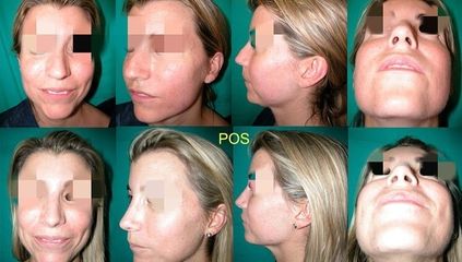 Rinoplastia