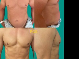 Marcación abdominal antes y después - 875271