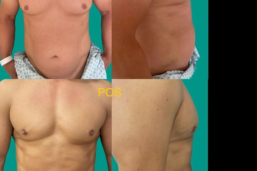 Marcación abdominal antes y después - 875271