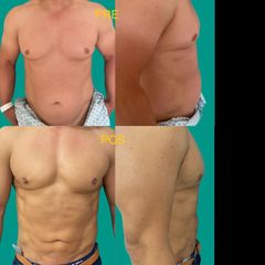 Marcación abdominal