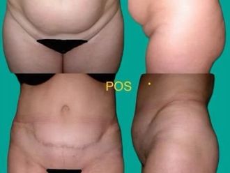 Abdominoplastia antes y después - 875272
