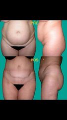 Abdominoplastia