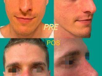 Rinoplastia antes y después - 875273