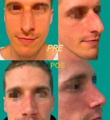 Rinoplastia
