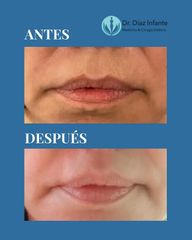 Aumento de labios - Dr. José Luis Díaz Infante