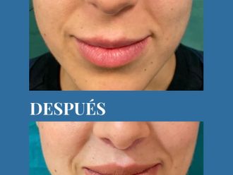 Aumento labios antes y después - 880693