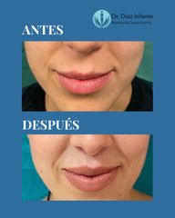 Aumento de labios - Dr. José Luis Díaz Infante