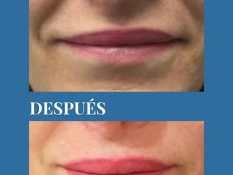Aumento labios antes y después - 880694