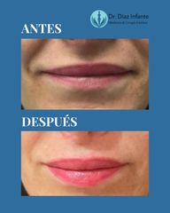 Aumento d labios - Dr. José Luis Díaz Infante