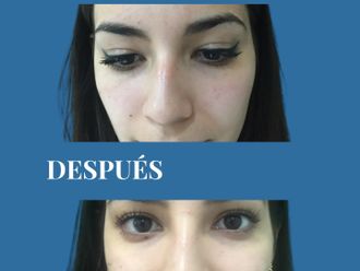 Rinoplastia antes y después - 880695