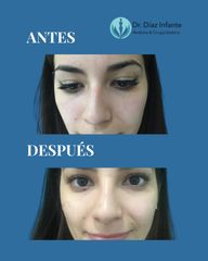 Rinoplastia - Dr. José Luis Díaz Infante