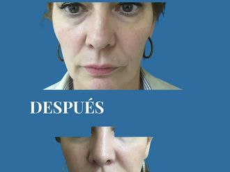 Rinoplastia antes y después - 880696