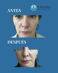 Rinoplastia - Dr. José Luis Díaz Infante