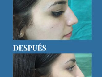 Rinoplastia antes y después - 880697