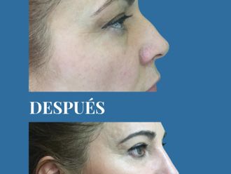 Rinoplastia antes y después - 880698