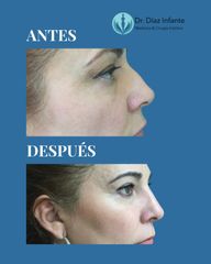 Rinoplastia - Dr. José Luis Díaz Infante
