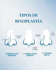 Rinoplastia - Dr. José Luis Díaz Infante