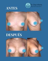 Aumento de pecho - Dr. José Luis Díaz Infante