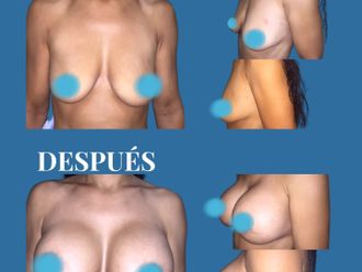 Aumento de pecho antes y después - 880702