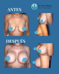 Aumento de pecho - Dr. José Luis Díaz Infante