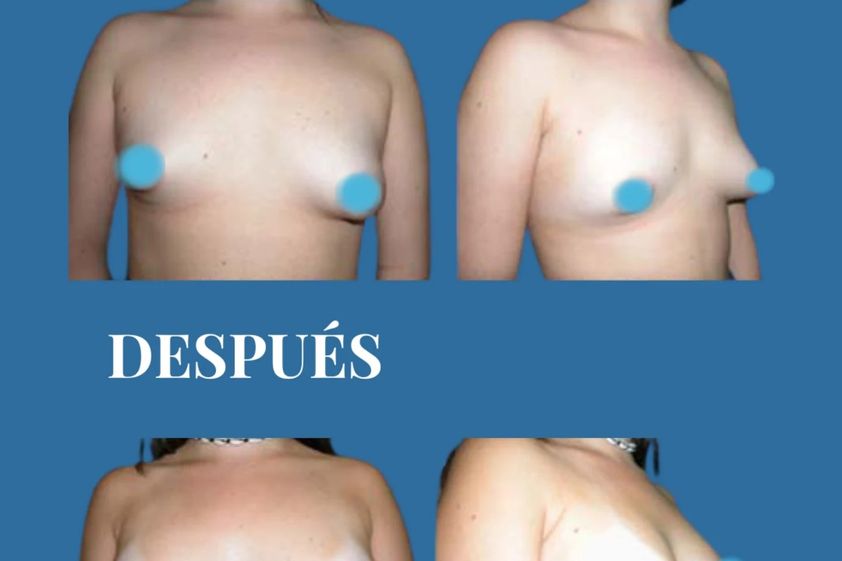 Aumento de pecho antes y después - 880706