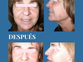 Rejuvenecimiento facial antes y después - 880707
