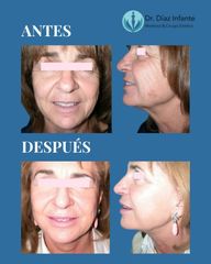 Rejuvenecimiento facial - Dr. José Luis Díaz Infante
