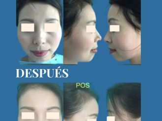 Aumento mentón antes y después - 880708