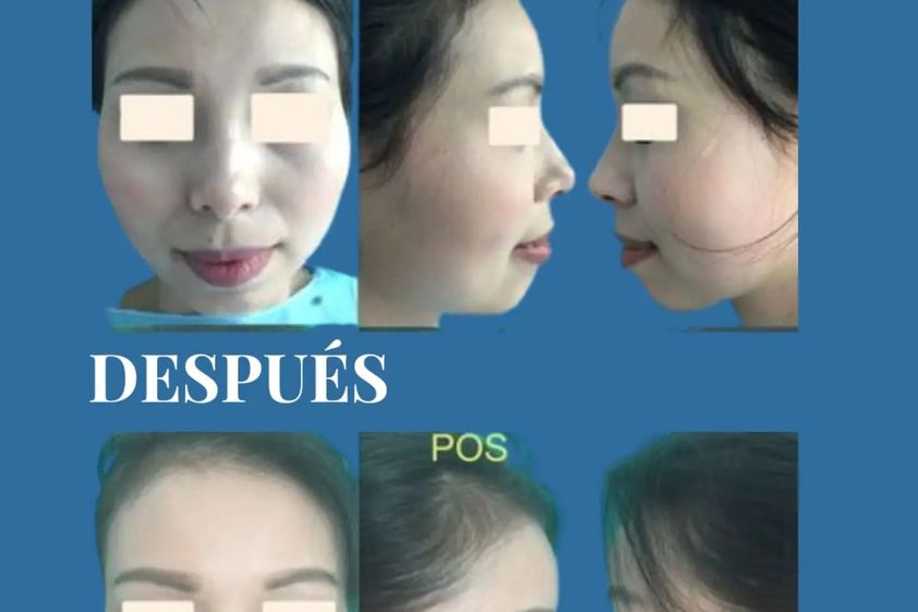 Aumento mentón antes y después - 880708