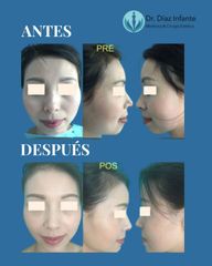 Mentoplastia - Dr. José Luis Díaz Infante