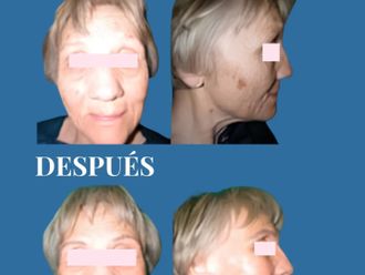 Rejuvenecimiento facial antes y después - 880709