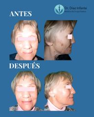 Rejuveneciemiento facial - Dr. José Luis Díaz Infante