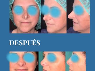 Rinoplastia antes y después - 881241