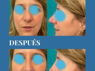 Rinoplastia antes y después - 881243
