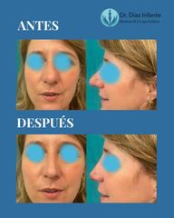 Rinoplastia