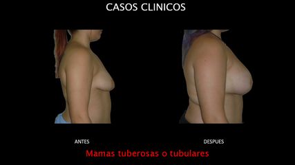 Mamas tuberosas - Contour Clinic