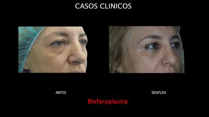 Blefaroplastia - Contour Clinic