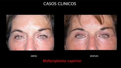 Blefaroplastia - Contour Clinic