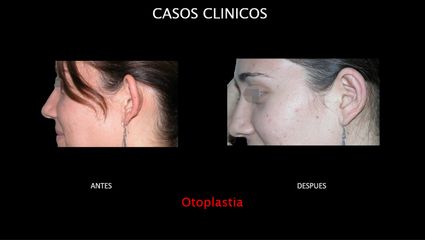 Otoplastia - Contour Clinic