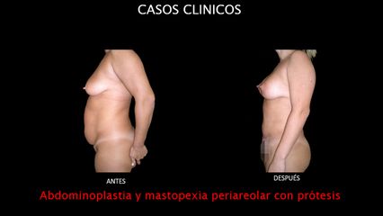 Abdominoplastia + Mastopexia - Contour Clinic