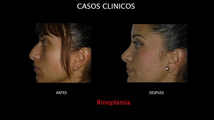 Rinoplastia - Contour Clinic