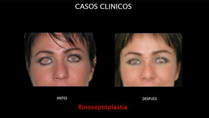 Rinoplastia - Contour Clinic