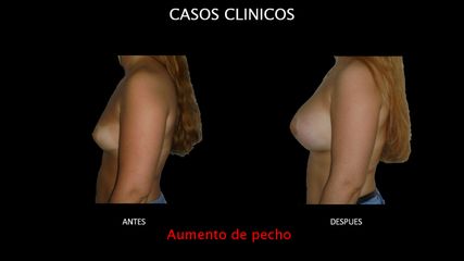 Aumento de pecho - Contour Clinic