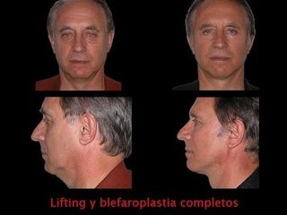 Lifting + Blefaroplastia - Contour Clinic