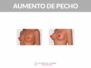 AUMENTO DE PECHO - Contour Clinic