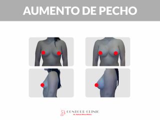 AUMENTO DE PECHO - Contour Clinic