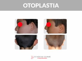 OTOPLASTIA - Contour Clinic