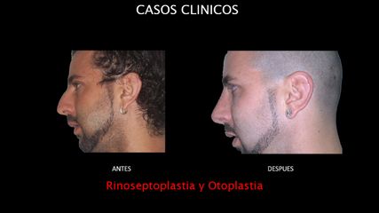 Rinoplastia + Otoplastia - Contour Clinic