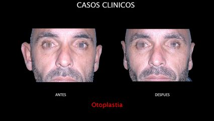 Otoplastia - Contour Clinic