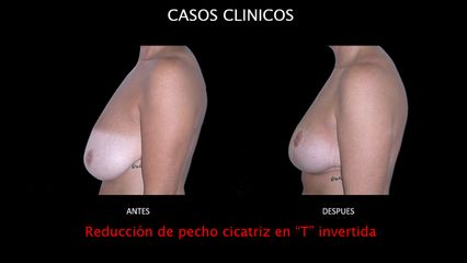 Reducción de senos - Contour Clinic